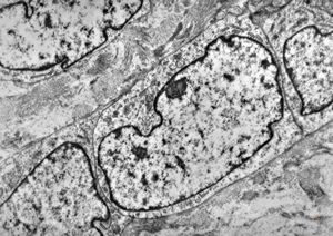 M,1y. | neuroblastoma - submandibular region